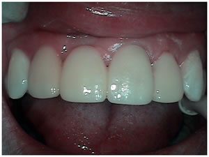After picture of bridge treatment teeth