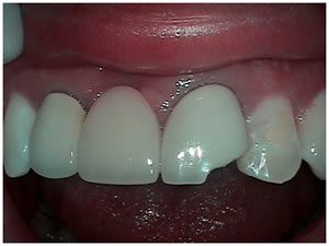 Before picture of front tooth before bridge treatment