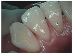 After picture of teeth cleaning treatment